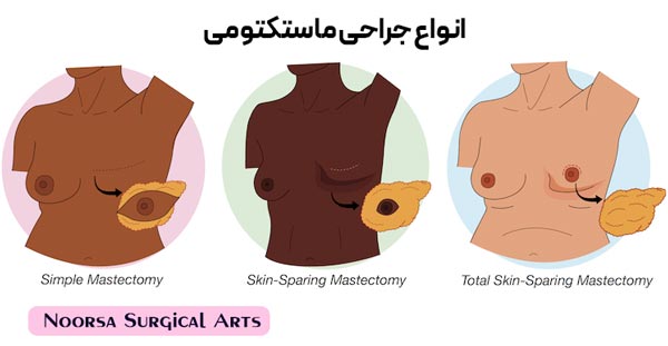 انواع جراحی ماستکتومی