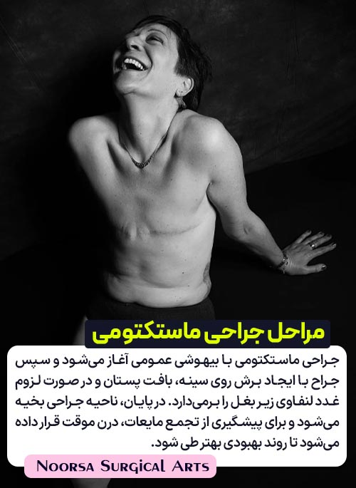 مراحل جراحی ماستکتومی