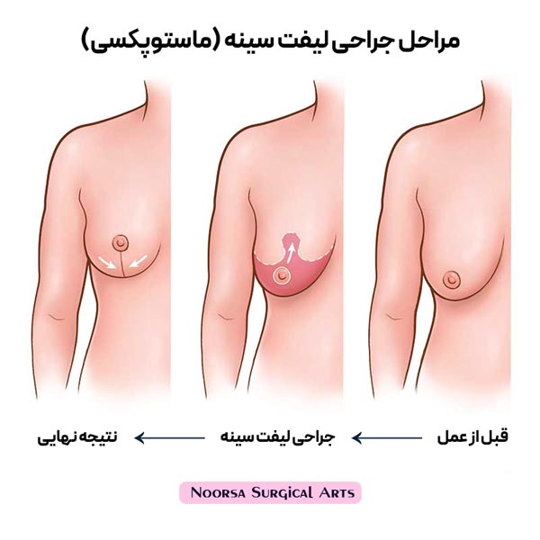 مراحل جراحی لیفت سینه