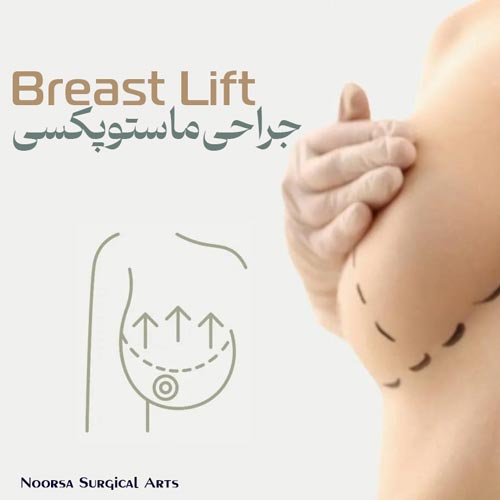 جراحی ماستوپکسی