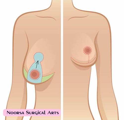 لیفت سینه با جراحی ماستوپکسی