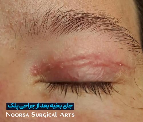 اسکار بعد از جراحی زیبایی پلک