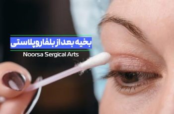 درمان بخیه بعد از بلفاروپلاستی