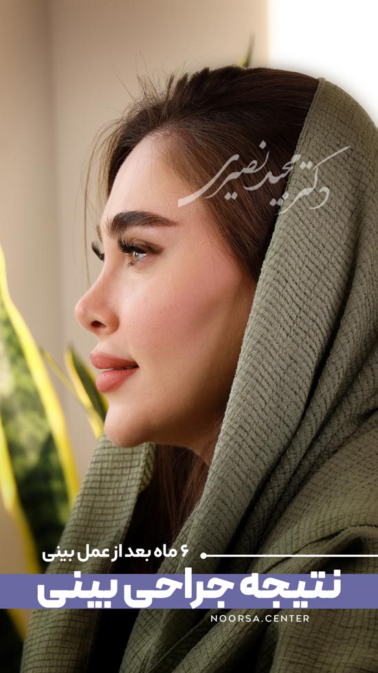 نتیجه جراحی بینی ترمیمی بعد از ۶ ماه