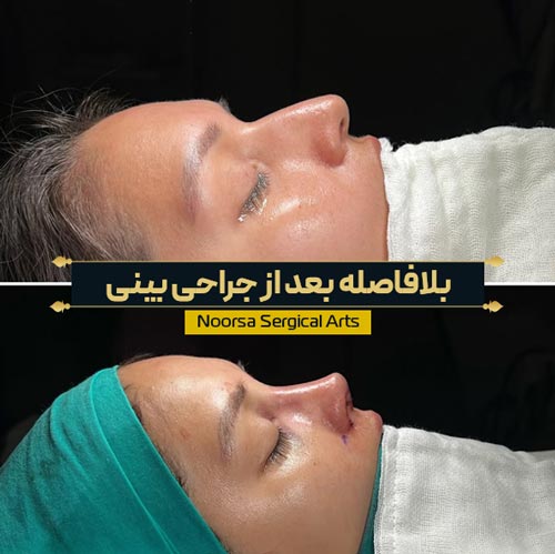 قبل و بعد از جراحی بینی نیمه فانتزی