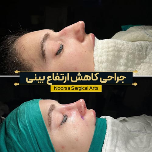 نتیجه جراحی کاهش ارتفاع بینی