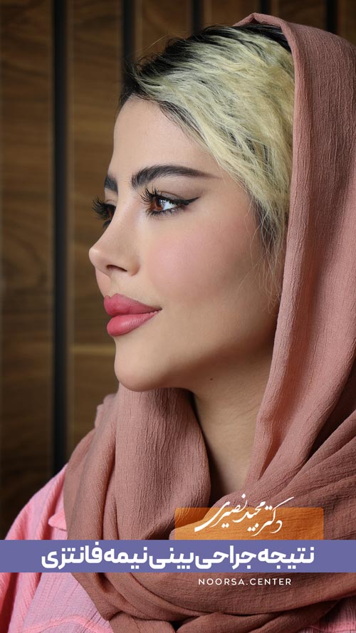 نتیجه جراحی بینی نیمه فانتزی