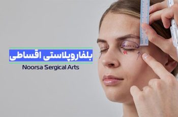 بلفاروپلاستی با پرداخت اقساطی
