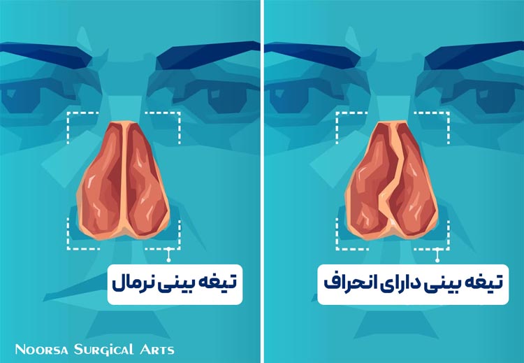 شماتیک تیغه بینی دارای انحراف