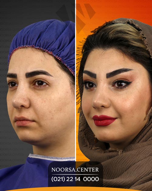 لیفت شقیقه اندوسکوپیک