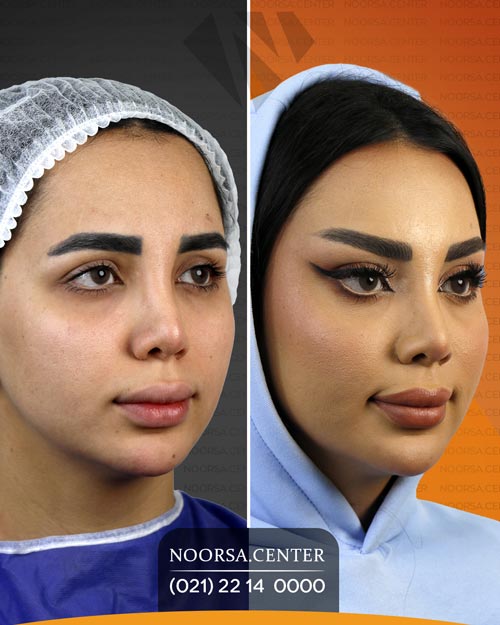 نتیجه لیفت شقیقه اندوسکوپیک