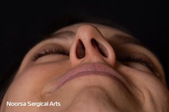 انحراف تیغه بینی