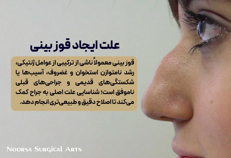 علت ایجاد قوز بینی