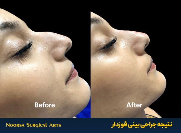 قبل و بعد از جراحی بینی قوزدار