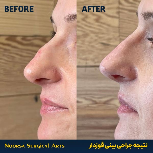 نتیجه جراحی قوز بینی