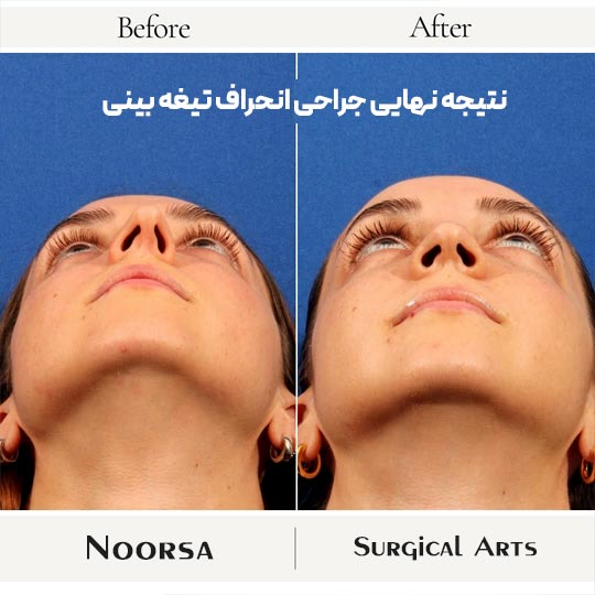 نتیجه جراحی سپتوپلاستی