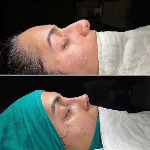 جراحی بینی نیمه فانتزی