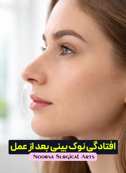 افتادگی نوک بینی بعد از عمل