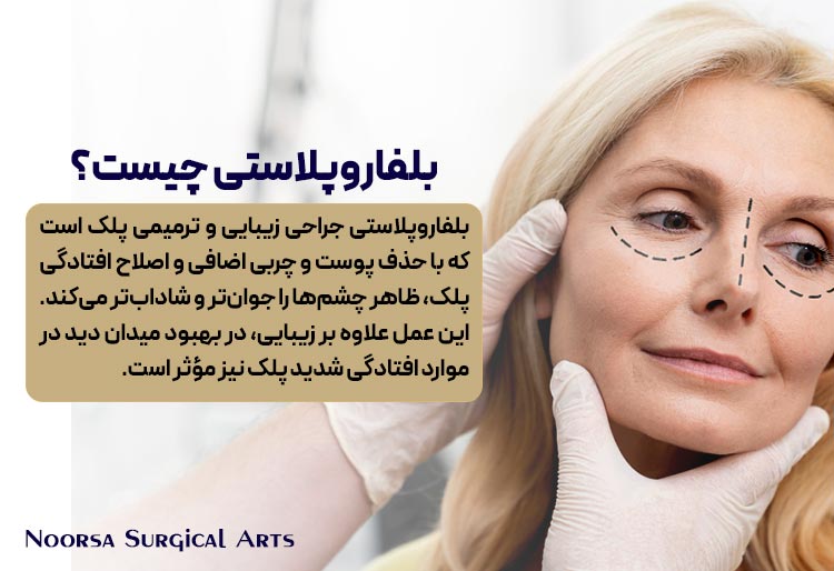 بلفاروپلاستی چیست ؟