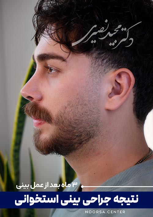 نتیجه جراحی بینی استخوانی