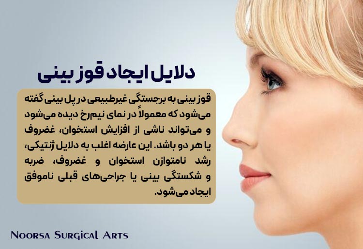 دلایل ایجاد قوز بینی