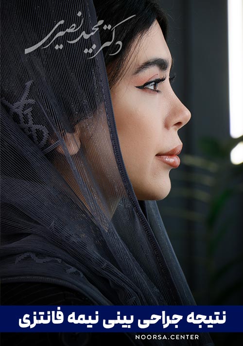نتیجه جراحی بینی نیمه فانتزی