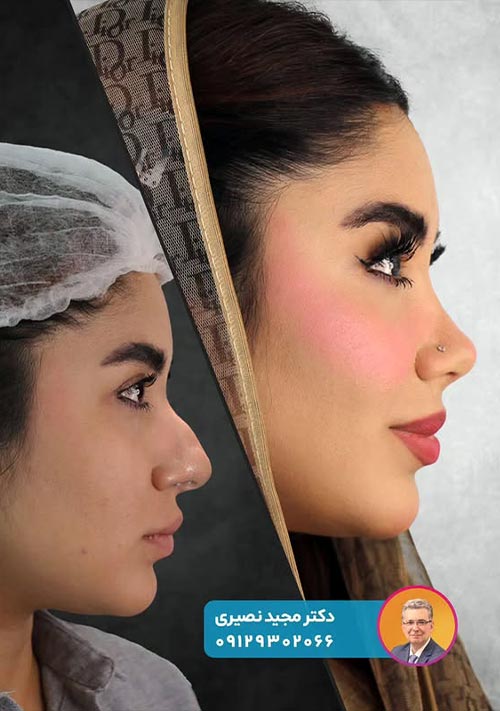 جراحی رفع قوز بینی