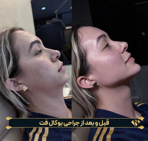 قبل و بعد از جراحی بوکال فت