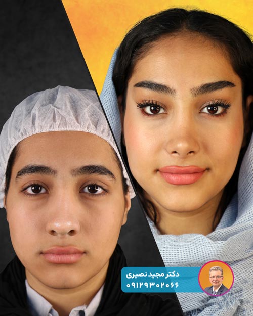 نمونه جراحی بینی در نوجوانان