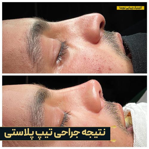 نتیجه جراحی تیپ پلاستی