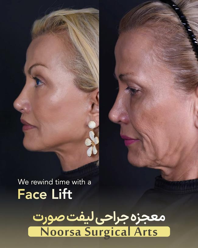 نتیجه جراحی لیفت صورت