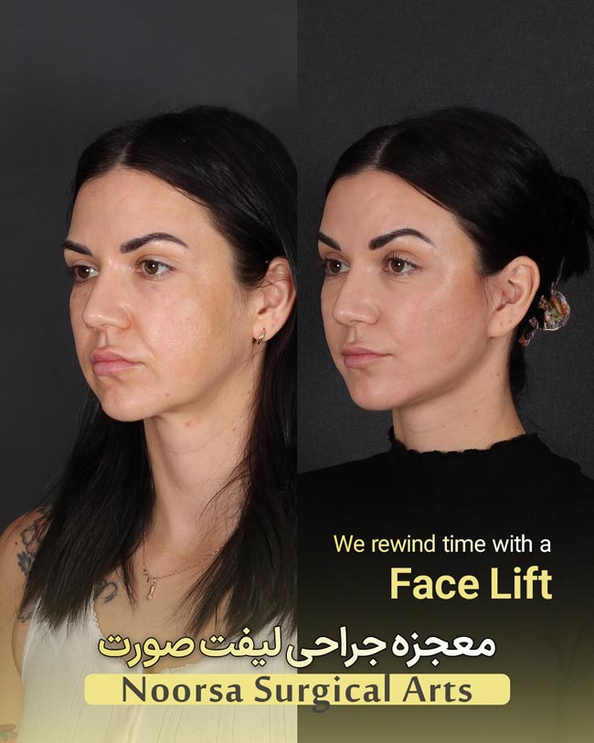 نتیجه جراحی لیفت صورت