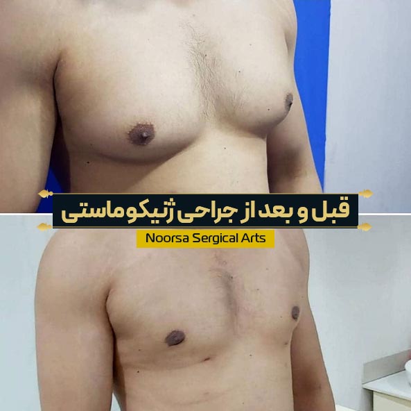 قبل و بعد از جراحی ژنیکوماستی