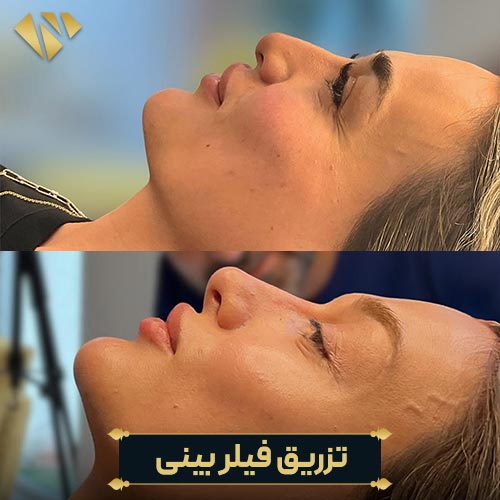 تزریق فیلر بینی