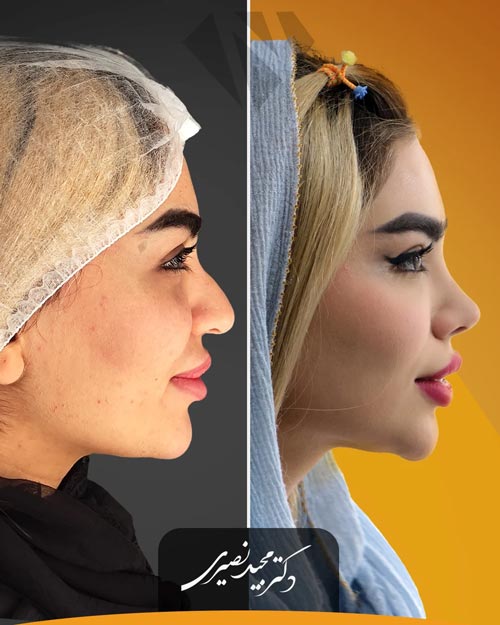 اصلاح فرم نوک بینی با جراحی