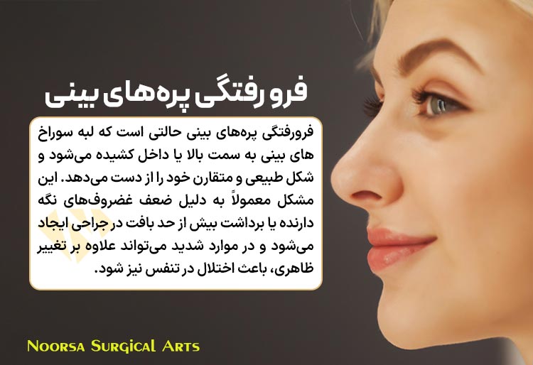فرو رفتگی پره های بینی