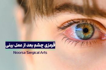 قرمزی چشم بعد از عمل بینی