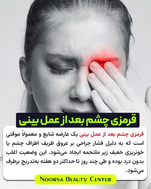 قرمزی چشم بعد از جراحی بینی