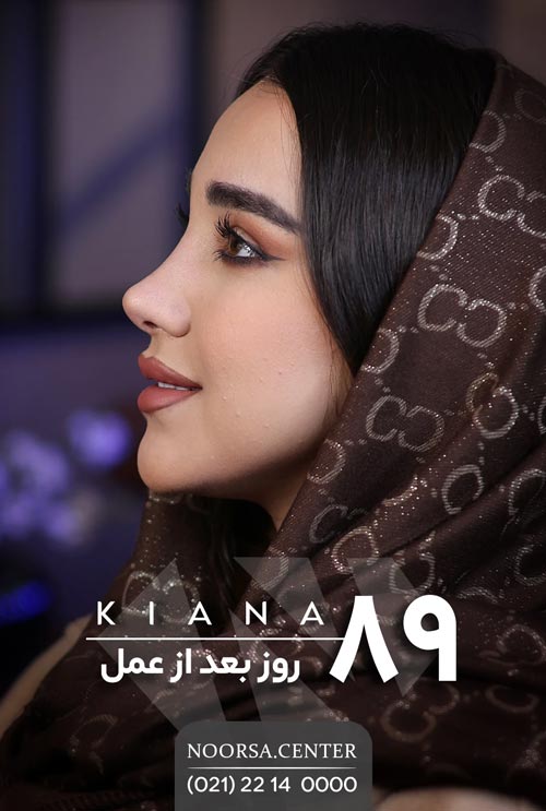 نتیجه جراحی بینی بعد از ۸۹ روز