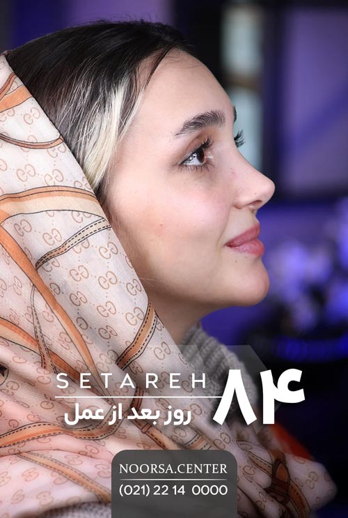 نتیجه جراحی بینی نیمه فانتزی با تکنیک سدیشن