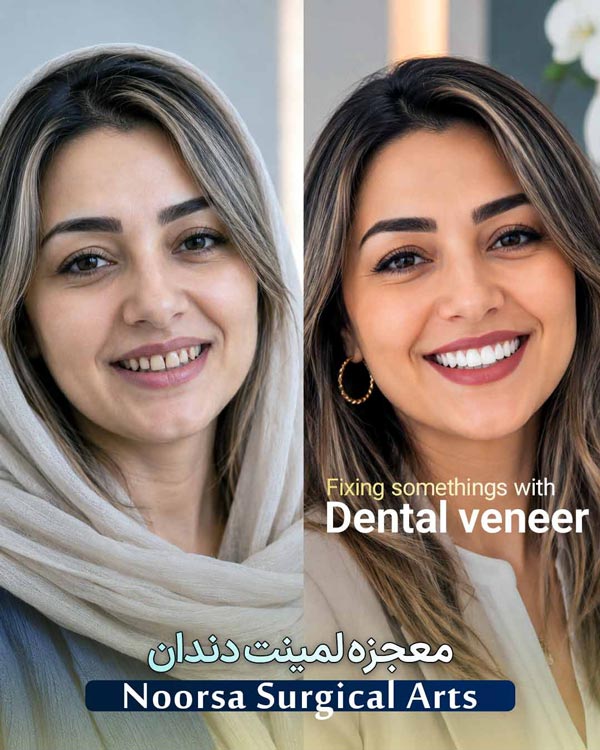 قبل و بعد از لمینت دندان