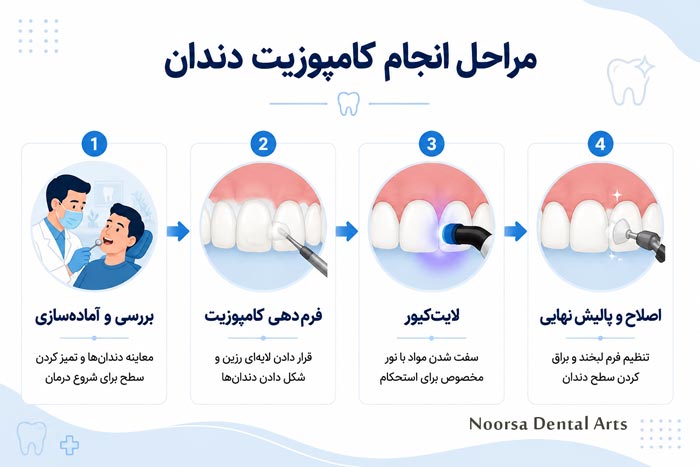 مراحل انجام کامپوزیت دندان