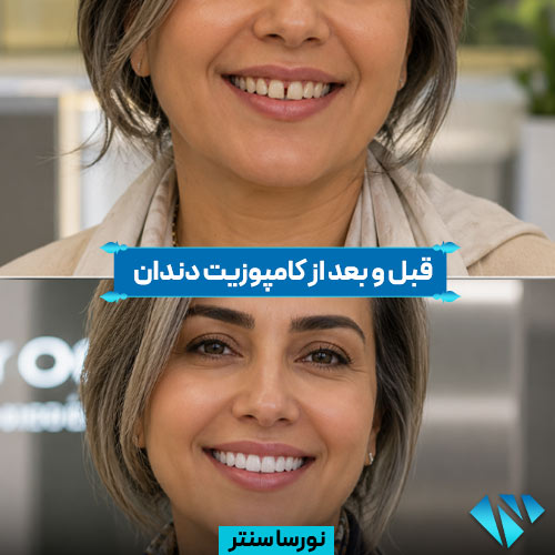 قبل و بعد از کامپوزیت دندان