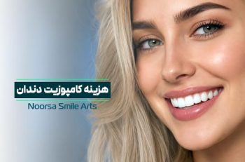 هزینه کامپوزیت دندان