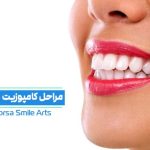 راهنمای کامل مراحل کامپوزیت دندان؛ از مشاوره تا لبخند نهایی