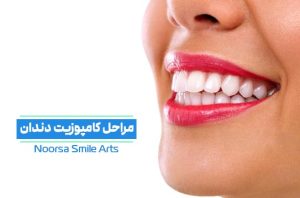 مراحل کامپوزیت دندان