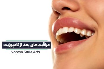 مراقبت های بعد از کامپوزیت دندان