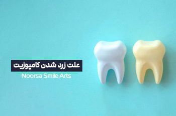 علت زرد شدن کامپوزیت دندان چیست