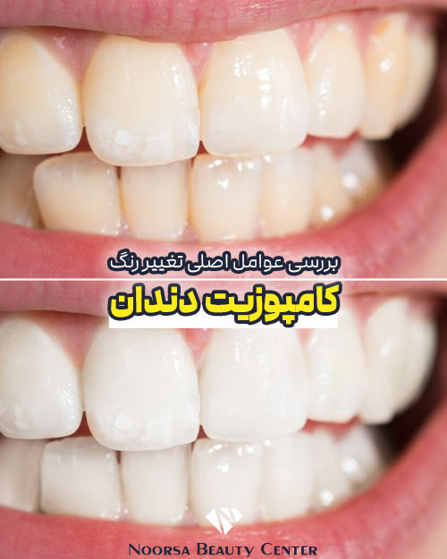 بررسی عوامل تغییر رنگ کامپوزیت دندان