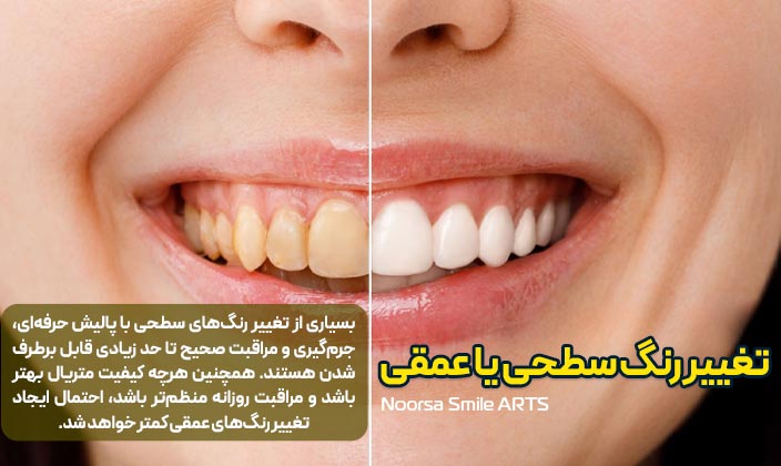 تغییر رنگ سطحی یا عمقی کامپوزیت دندان